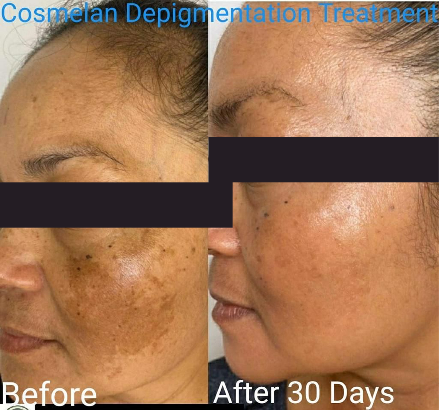 Alar Reduction result KOQ10